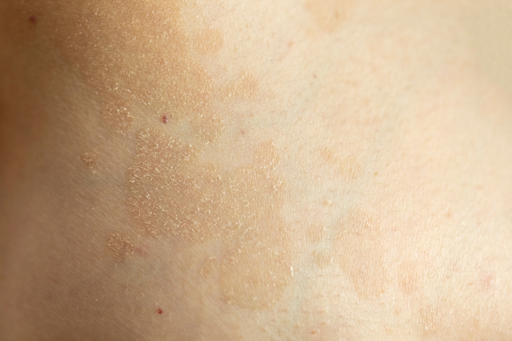 Pityriasis versicolor - škvrny na koži